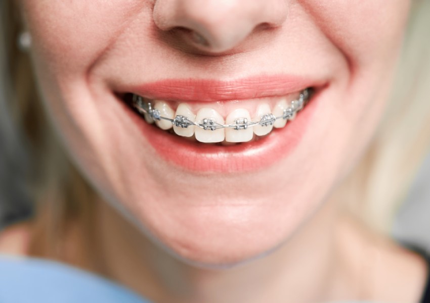 Brackets autoligables