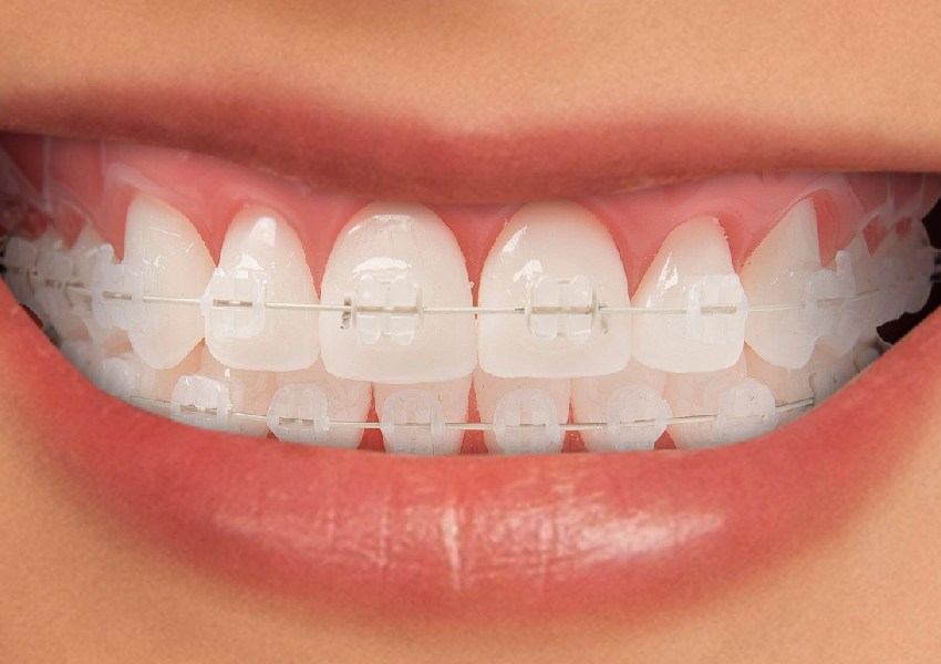 Brackets cerámicos