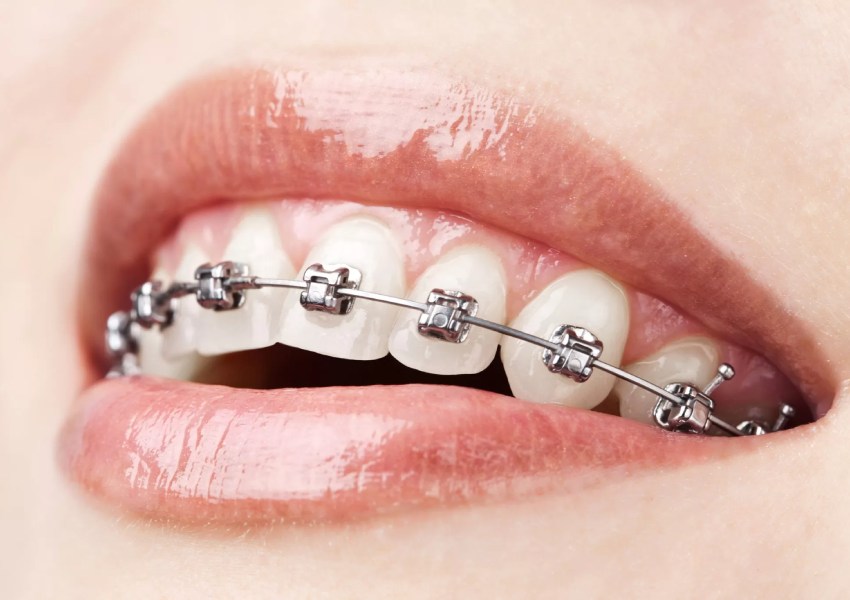 Brackets mini